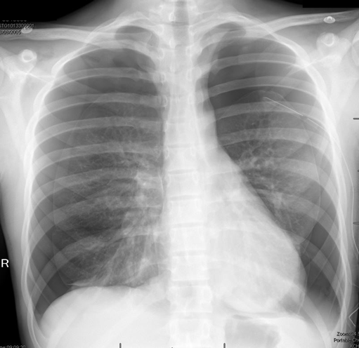 CXR showing of a 15 year old boy with a bilateral PSP at presentation. There is a 12 Fr chest drain inserted on the left but neither lung is up and the boy is still symptomatic. Suction was applied at 5-10cm H20 and a chest tube on the other side was inserted. The patient failed clamping of the drain after 3 days and re-accumulated quickly. He underwent bilateral VATS with apicectomies and mechanical pleurodesis (2 port) – one week apart.