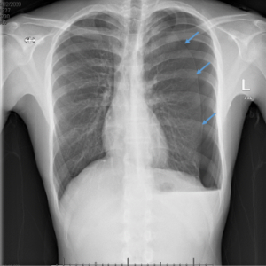 Bilateral pneumothorax