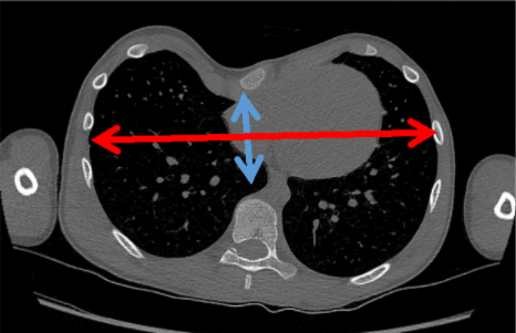 Example of patient with chest wall asymmetry. (A) Patient's