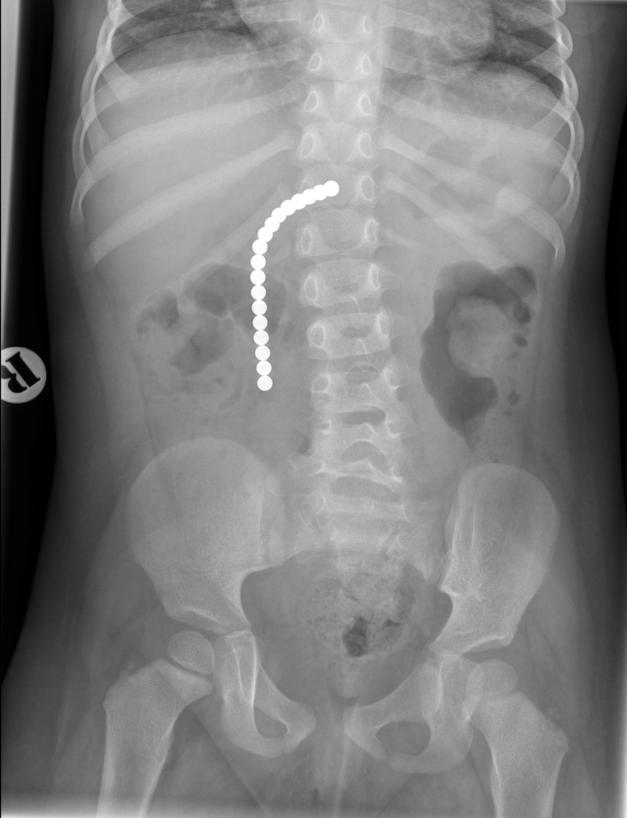 Little magnets are a big health hazard when swallowed